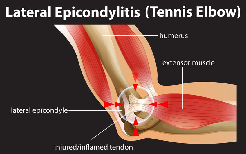 Elbow Injury